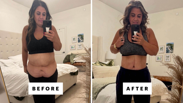 skin removal surgery before and after